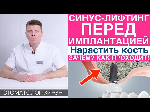 Видео: Синус-лифтинг - наращивание костной ткани перед имплантацией зубов. Установка зубных имплантов.