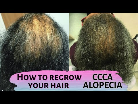Видео: Как восстановить волосы | Алопеция CCCA | Уход за волосами при центральной центробежной рубцовой ...