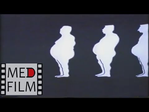 Видео: Пиквикский синдром © Pickwick syndrom