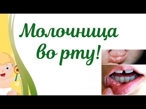 Видео: Молочница ротовой полости у ребенка!👶 Что делать?