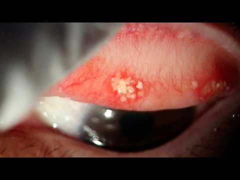 Видео: Удаление глазных камней: как вы жили с таким количеством?