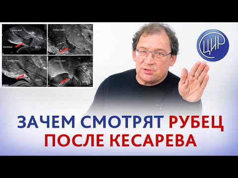 Видео: Рубец на матке после кесарева сечения. Что на самом деле смотрит врач когда оценивает рубец на матке