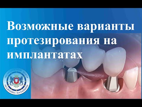 Видео: Возможные варианты протезирования на имплантатах