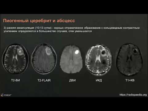 Видео: Вебинар МРО РОРР: Нейроинфекции много лиц одного процесса