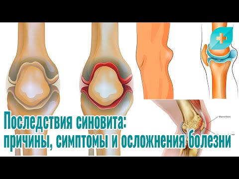 Видео: Последствия синовита: причины, симптомы и осложнения болезни