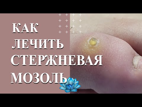 Видео: Стержневая мозоль на пальце. Как лечить мозоль.