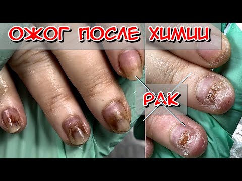 Видео: Ожог ногтей после химиотерапии / Ногти после рака / Ногти после химии / Ожог ногтей / #Nails #Ногти