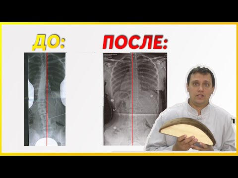 Видео: ПОЯСНИЦА пройдёт СРАЗУ! Убираем боль ДОМА | Подушка Мейрама: стоит ли покупать?  Убрать сколиоз дома