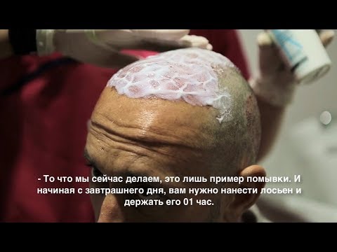 Видео: Как нужно мыть голову после пересадки волос.