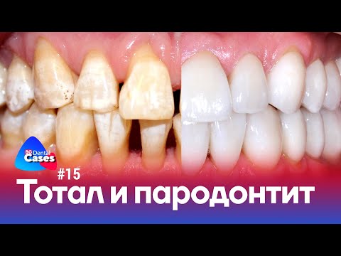 Видео: Тотальная реабилитация и пародонтит | Дентал кейсы от BG #15