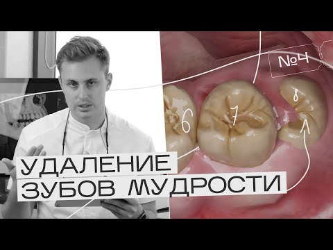 Видео: Удаление дистопированных и ретинированных зубов мудрости на верхней челюсти. Игорь Налиткин