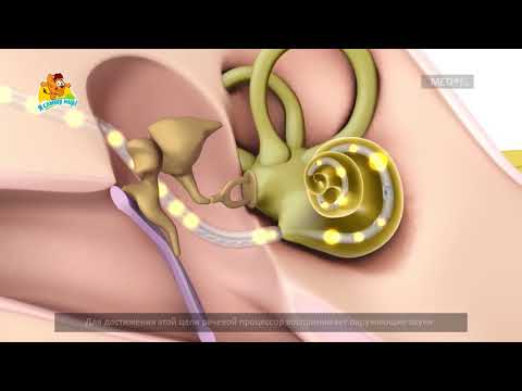 Видео: Как работает система кохлеарной имплантации? (субтитры)