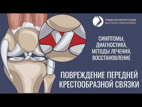 Видео: Повреждение передней крестообразной связки. Симптомы, диагностика, лечение, восстановление