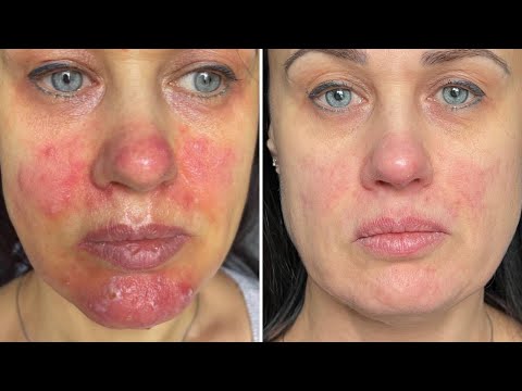 Видео: Результат до/после лечения розацеа по методике by Perevalova.Дерматолог Перевалова Елена Геннадьевна