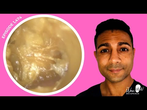 Видео: 1474 - Сложное удаление экзематозного наружного отита из обоих наружных слуховых проходов