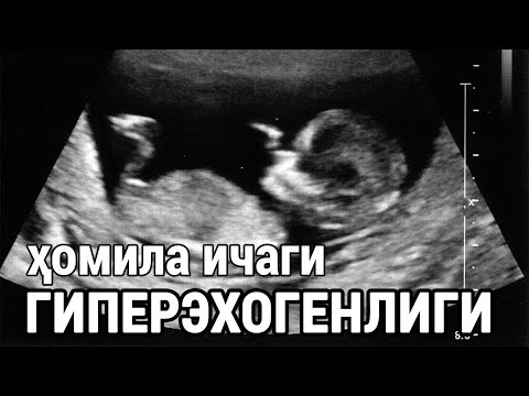 Видео: Ҳомила ичаги гиперэхогенлиги