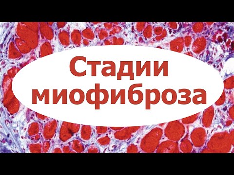 Видео: Стадии миофиброза. УЗИ мышц