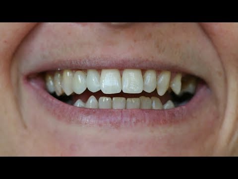 Видео: Адхезивен мост