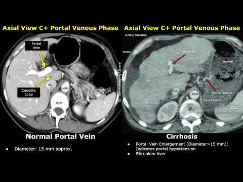 Видео: КТ печени: нормальные и циррозные изображения | Неровные края, спленомегалия, портальная гипертен...