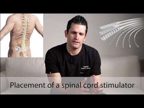 Видео: Размещение стимулятора спинного мозга