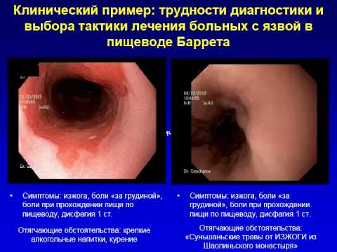 Видео: Кашин С.В. Ранний рак на фоне пищевода Баррета. Клинические демонстрации