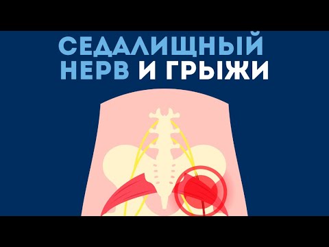 Видео: Седалищный нерв