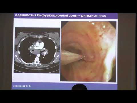 Видео: 16 Сивокозов ИВ Ригидная бронхоскопия Современные диагностические возможности
