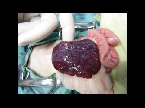 Видео: Павел Пульняшенко: ущемленная промежностная грыжа