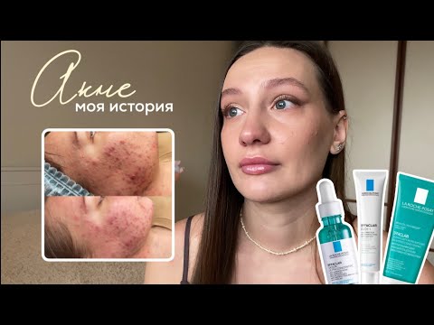 Видео: АКНЕ. МОЯ ИСТОРИЯ, ЛЕЧЕНИЕ БЕЗ РЕТИНОИДОВ