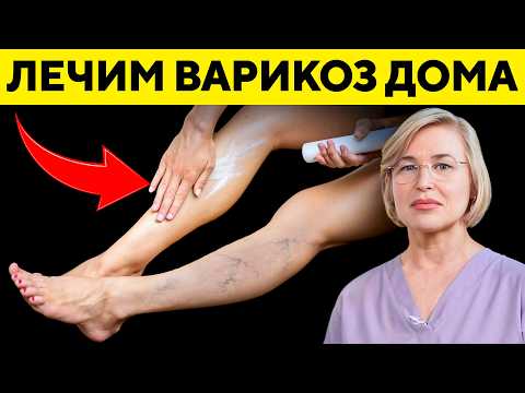 Видео: Как вылечить варикоз? Что делать нельзя? 2 упражнения восстанавливающие клапаны