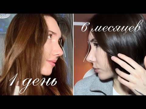 Видео: Риносептопластика спустя полгода: изменение формы носа, новые ощущения, ответы на вопросы