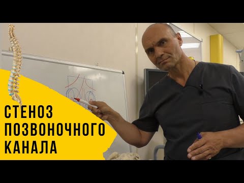 Видео: СТЕНОЗ СПИННОМОЗГОВОГО КАНАЛА ПОЗВОНОЧНИКА. 3 опасных симптома, причины и лечение.