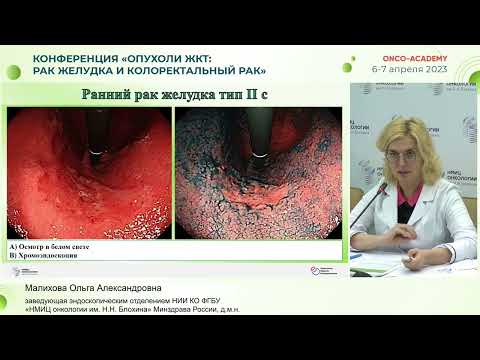 Видео: Up-date: актуальные данные диагностики и лечения раннего рака желудка. Малихова О. А.