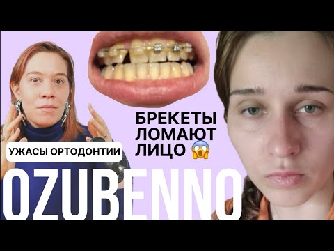 Видео: БРЕКЕТЫ СЛОМАЛИ МНЕ ЛИЦО |  Как и почему лишаются здоровья на брекетах