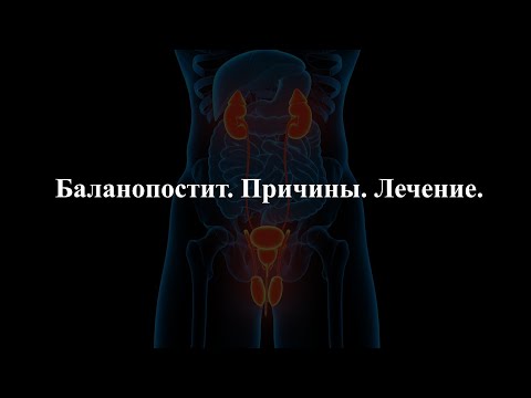 Видео: Баланопостит. Причины. Лечение.
