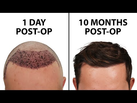 Видео: Как выглядит пересадка волос — неделя за неделей