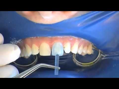 Видео: Система прямой композитной облицовки COMPONEER — длинная версия