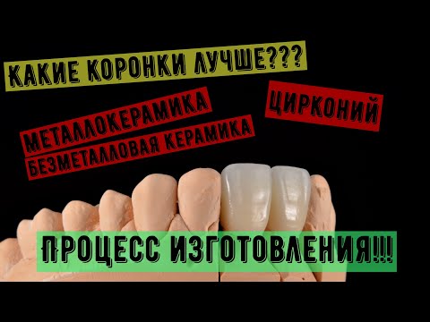 Видео: Какие коронки на зубы лучше? Металлокерамика, Цирконий, emax. Процесс работы. Изготовление коронок.