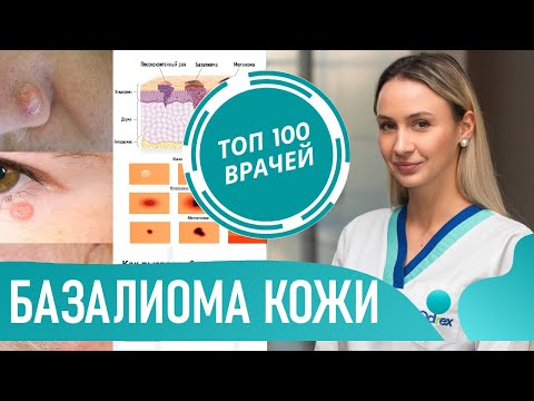 Видео: Как выглядит базалиома (фото 1-7). Базальноклеточный рак кожи. Базальноклеточная карцинома