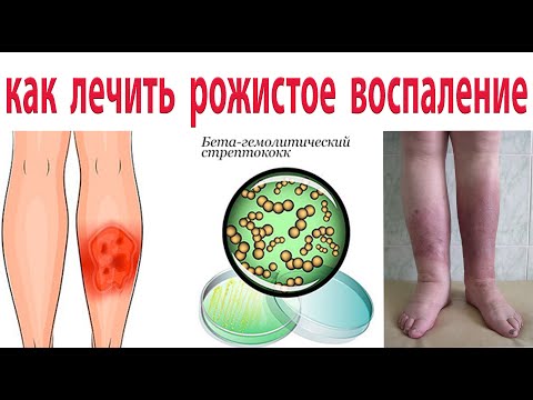 Видео: Как вылечить рожистое воспаление. Полная схема лечения. Эффективность 99% !!!