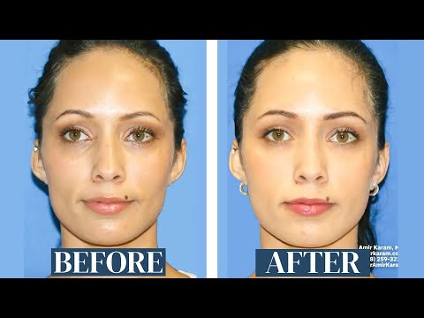 Видео: Результаты пересадки жира на лицо 9 лет спустя | Пересадка жира на щеки, под глаза и виски