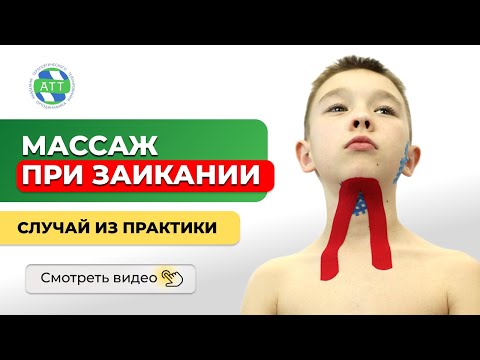 Видео: Логопедический массаж.  Массаж при заикании.  Тейпирование.  Случай из практики.