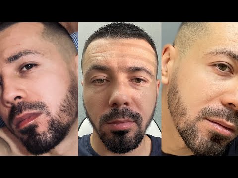 Видео: Миноксидил | 7 месяцев | Фотоотчёт