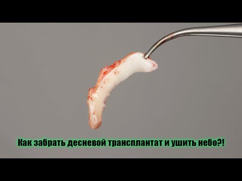 Видео: Забор десневого трансплантата с эпителием (СДТ) | Palatal free gingival graft (FGG) harvesting