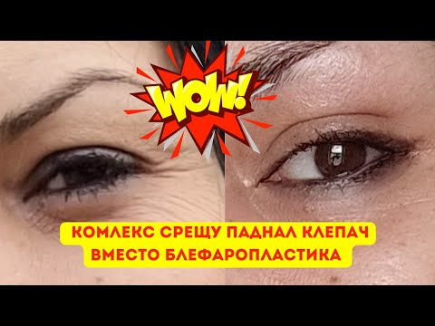 Видео: ТОП комлекс срещу ПАДНАЛ КЛЕПАЧ/Вместо блефаропластика