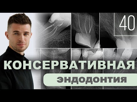 Видео: Консервативная эндодонтия. Уроки эндодонтии. Выпуск 40