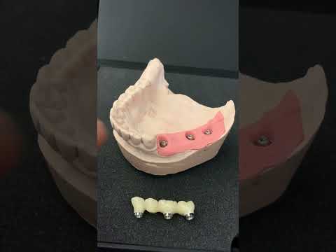 Видео: Винтовая фиксация мостовидного протеза из диоксида циркония с опорой на имплантаты. Важные нюансы