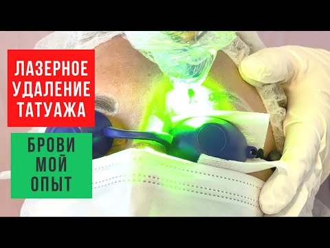 Видео: Лазерное удаление татуажа бровей. Мой опыт (вся процедура, заживление и советы)