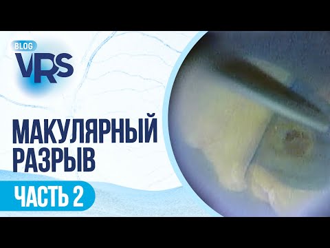 Видео: Макулярный разрыв / часть 2