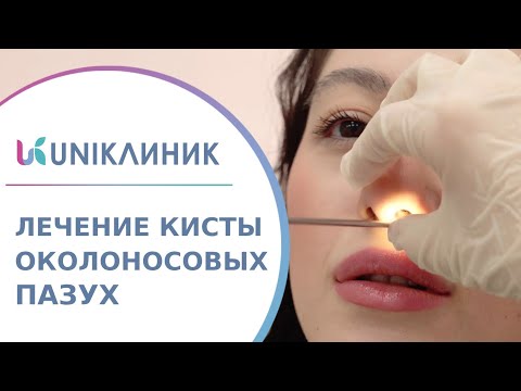 Видео: 👃 Диагностика и лечение кисты околоносовых пазух носа. Киста околоносовых пазух носа. UNIКлиник. 18+
